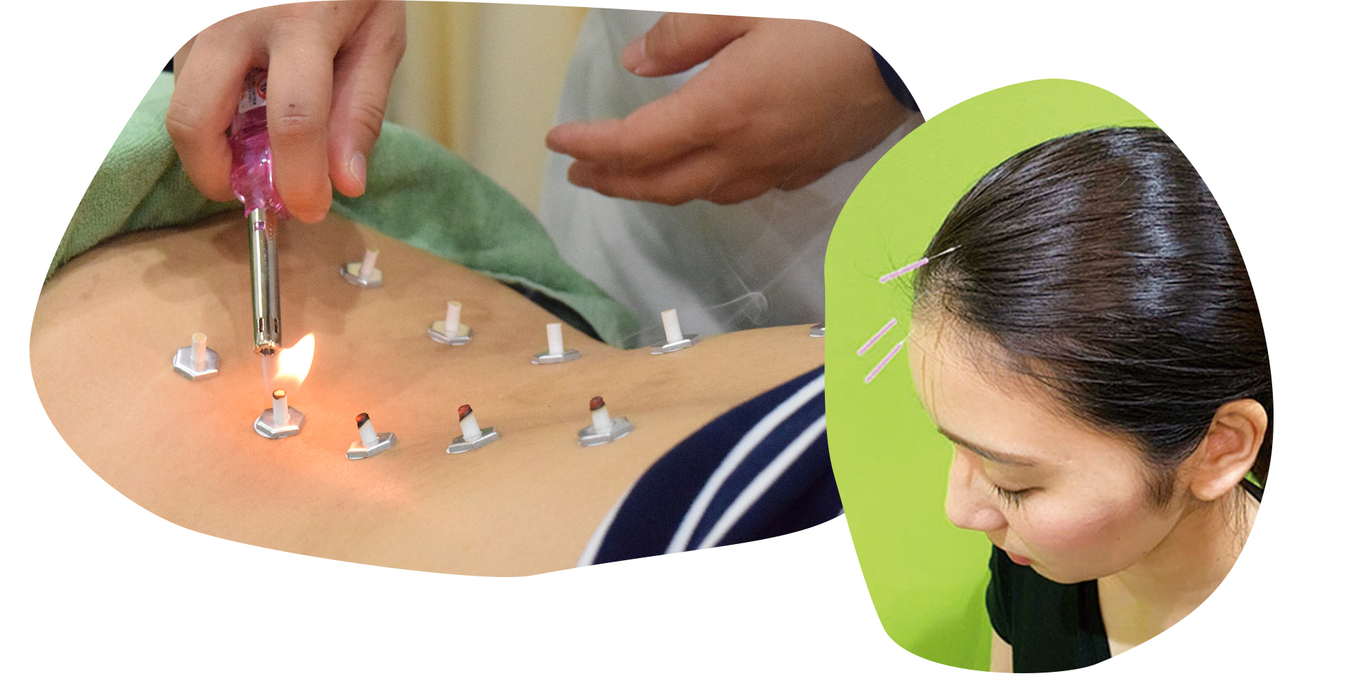 はり・きゅうとは？