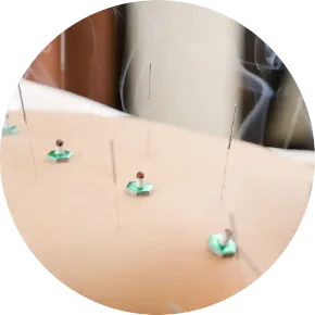 はり・きゅう治療